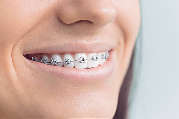 Best Traditional Braces  in Cuba, MO